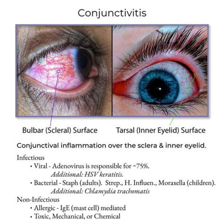 Conjunctivitis - How To Discuss