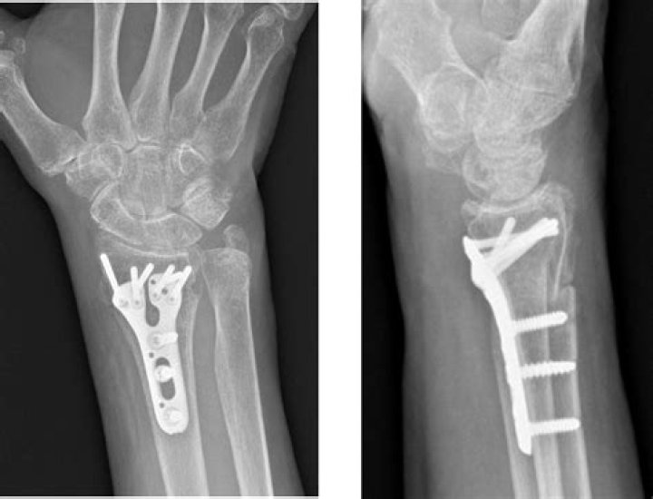 How To Fake A Broken Wrist