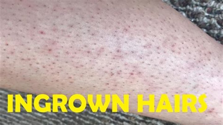 How to get rid of ingrown hair on legs