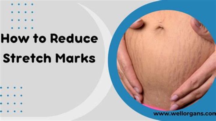 How to reduce stretch marks