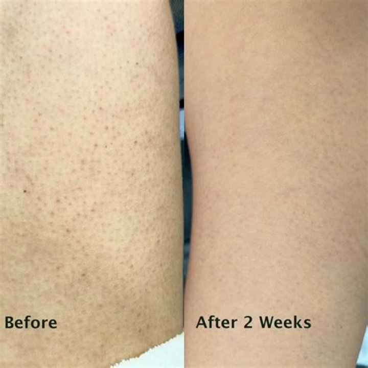 Keratosis pilaris before and after