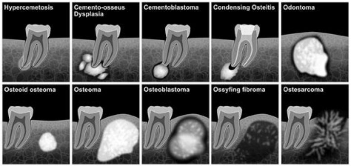 Osteosclerosis - How To Discuss