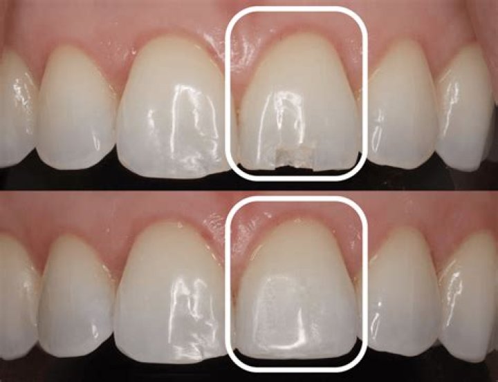 Quick Answer: How To Repair Chipped Enamel Jewelry