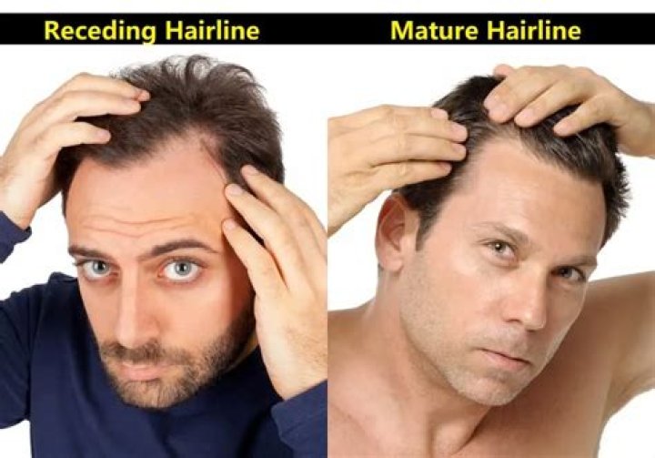 Receding hairline - How To Discuss