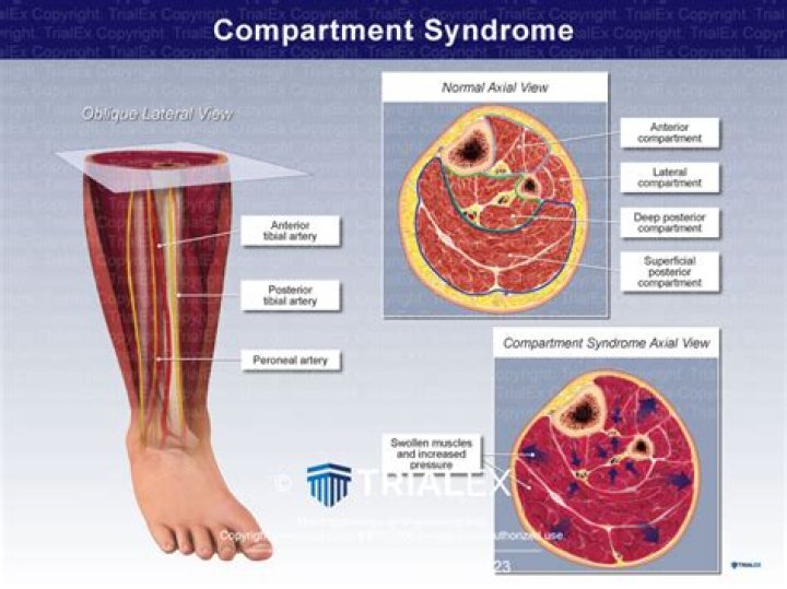 What are the findings of compartment syndrome?