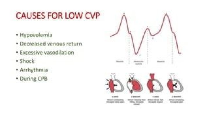 What causes high CVP
