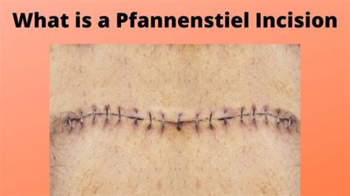 What is a Pfannenstiel skin incision