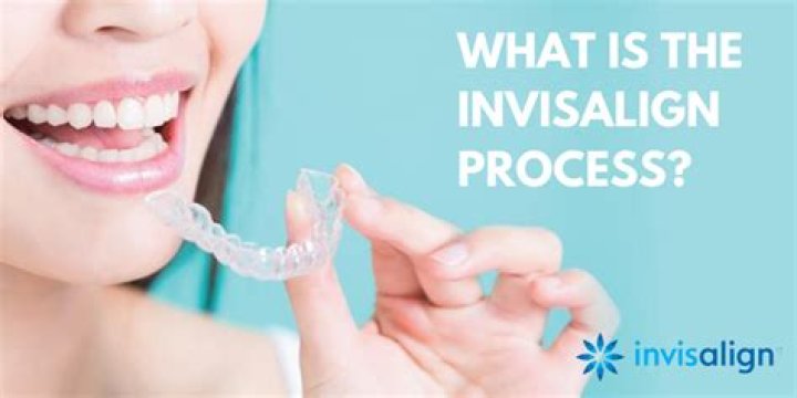What is the Invisalign process