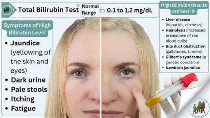 What is the principle of determination of total bilirubin