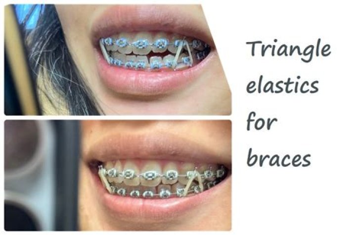 What is the purpose of elastics on braces?
