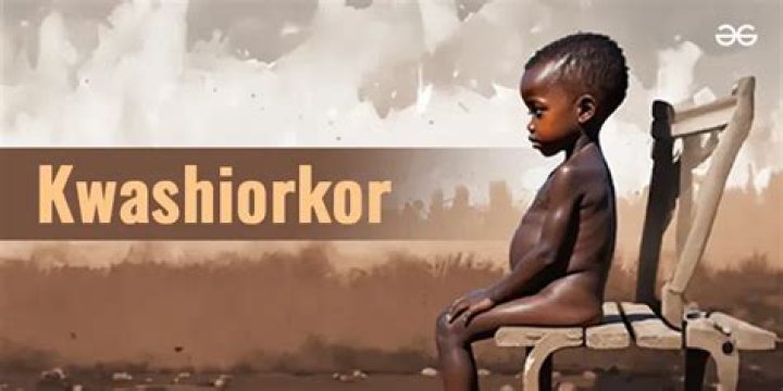 Where is kwashiorkor most common in the world