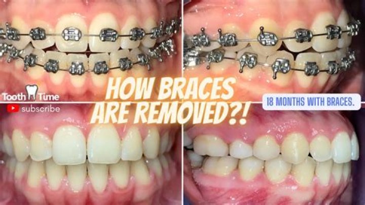 Why do loggers wear braces?