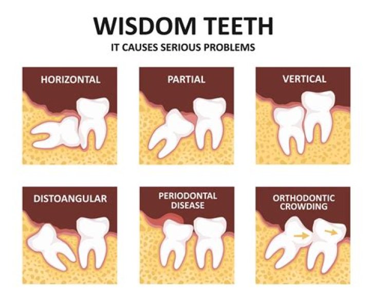 Wisdom Tooth Surgery - How To Discuss